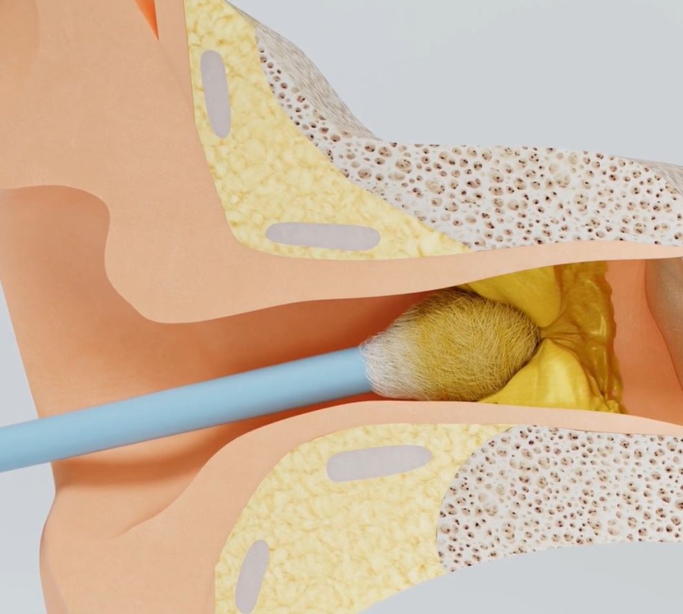 cotton swab inside ear with impacted earwax