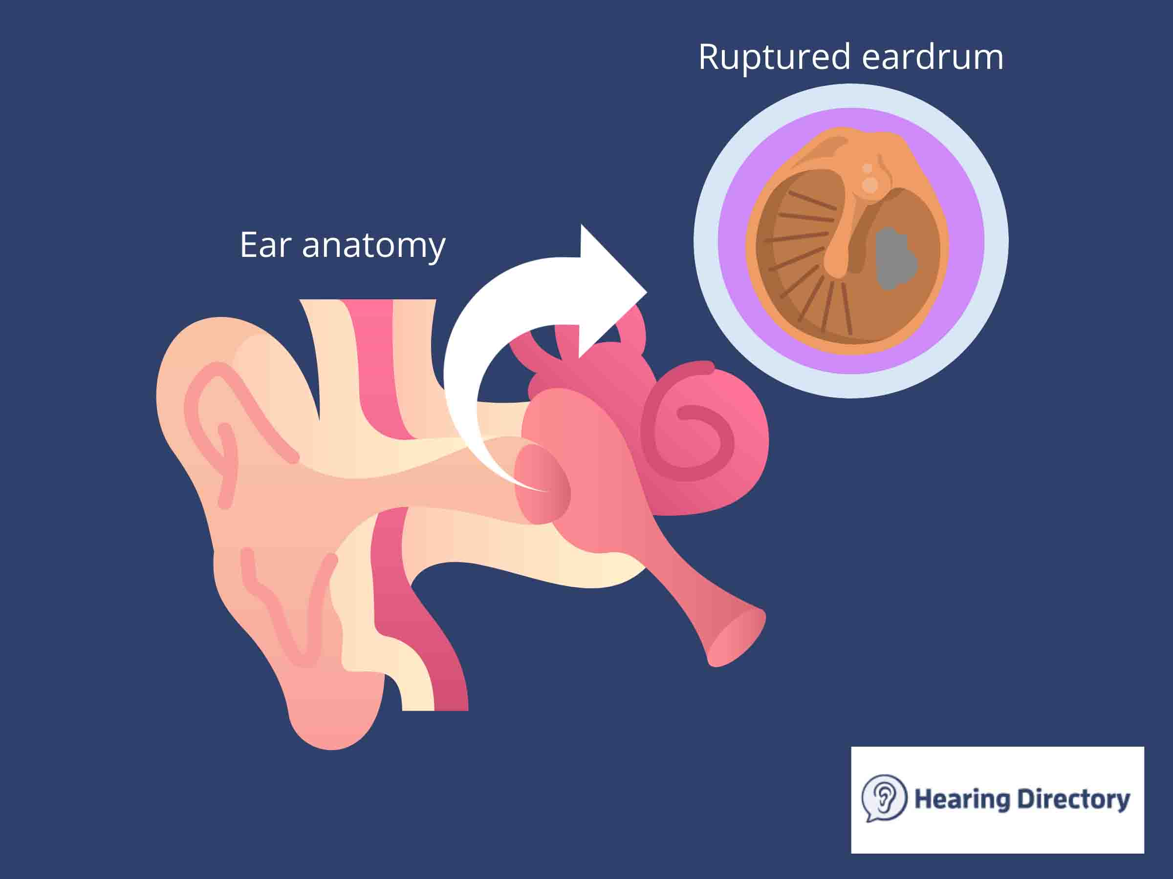 infographic of the ear anatomy and a ruptured eardrum
